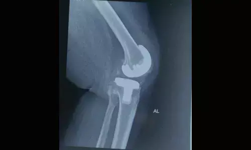 Aster doctors put Somalian with ‘metal allergy’ back on feet