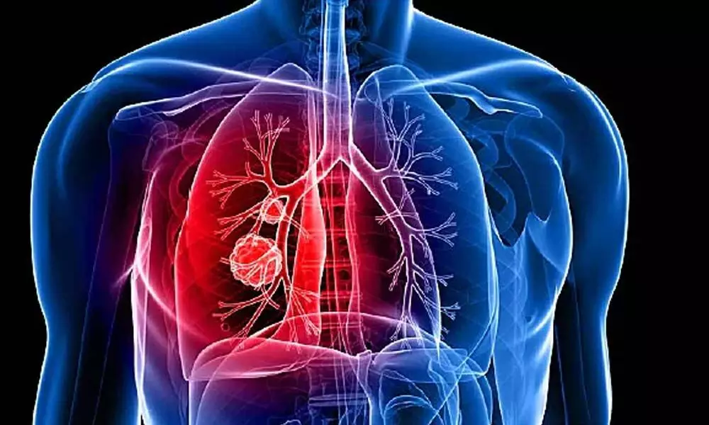 No definitive link between Covid-19, lung cancer: Doctors