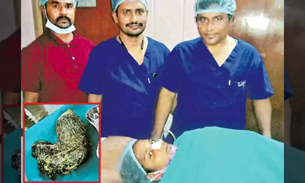 Hair ball removed from womans abdomen in Sangareddy