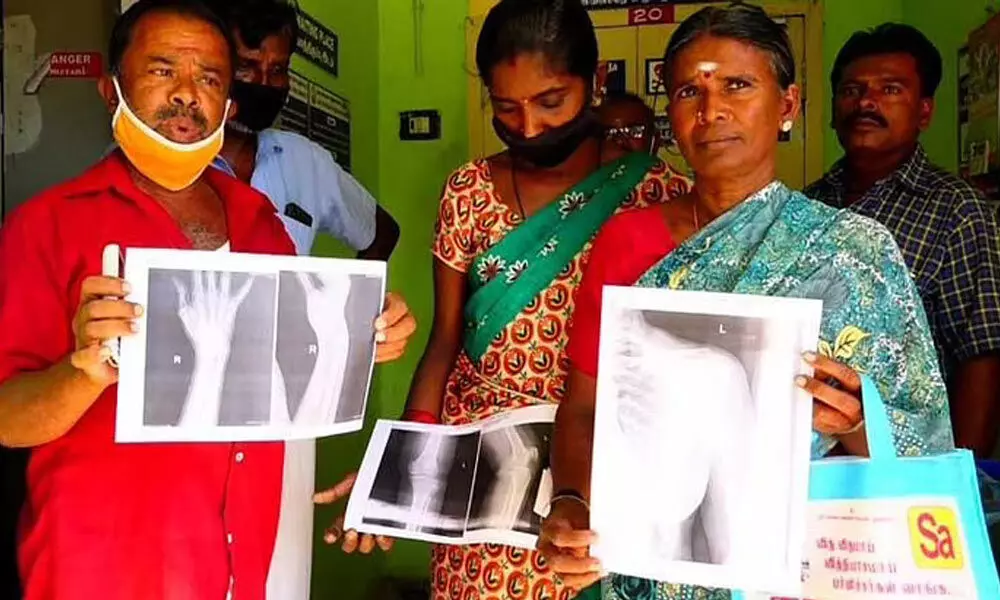The Kovilpatti Government Hospital issued X-ray findings on papers rather than films.