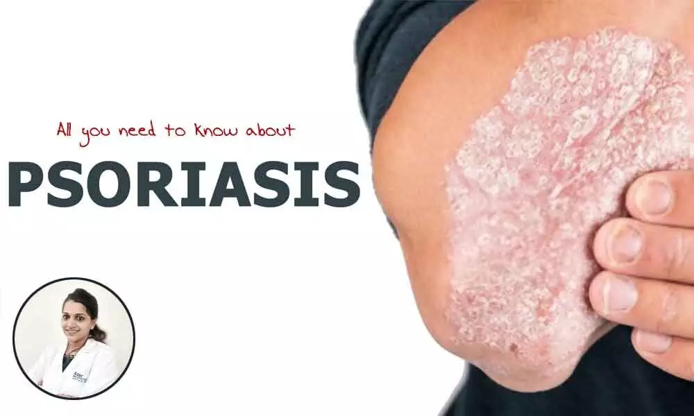 All you need to know about psoriasis