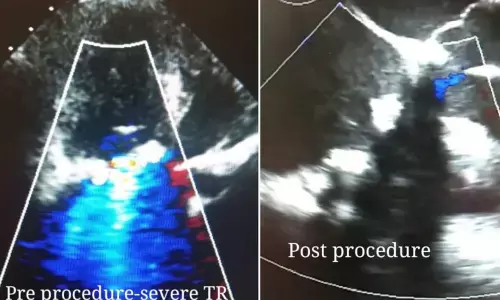 ECHO showing reduction in tricuspid regurgitation post valve-in-valve deployment