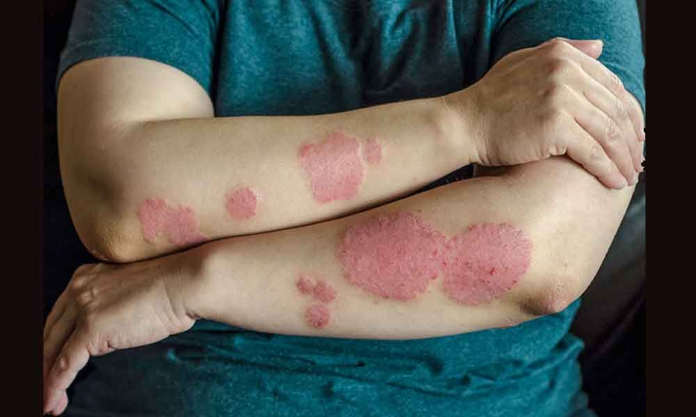 Psoriasis can worsen conditions if not managed well