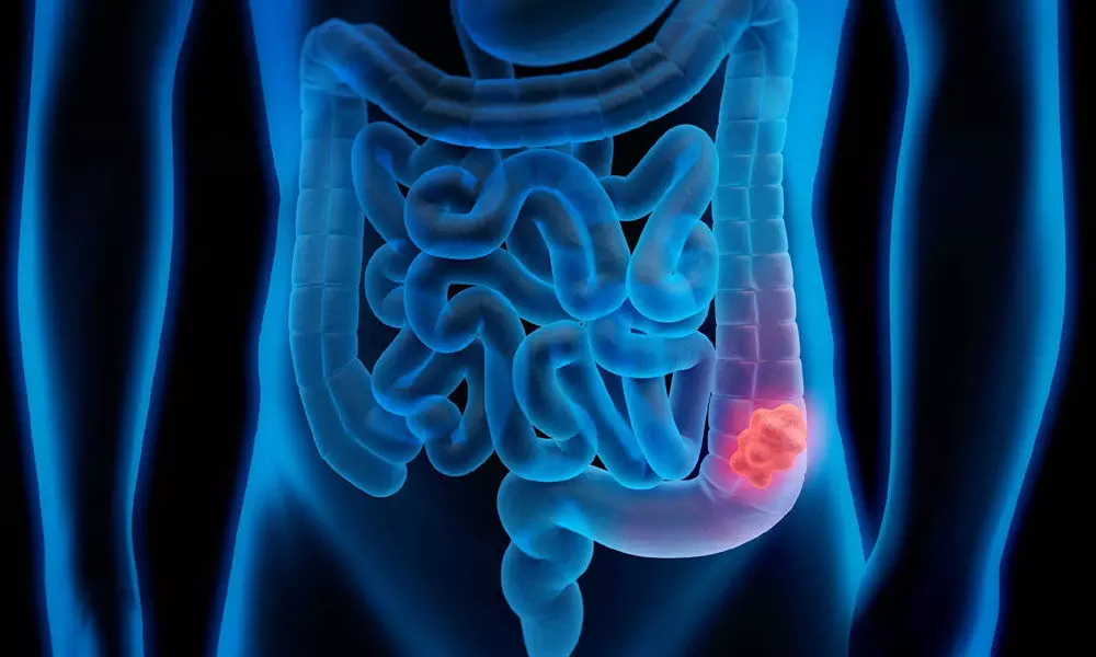 Lifestyle changes key to reduce risk of colon cancer