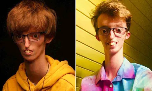 Dylan Lombard is one of 13 people in the world with a rare condition that prevents him from retaining fat.