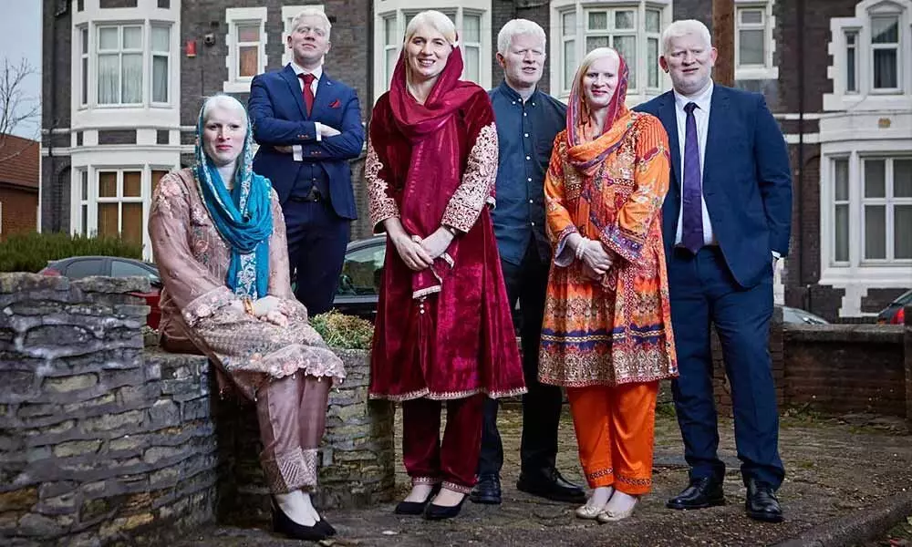 Family From British Holds New Guinness World Record For Having Six Siblings With Albinism