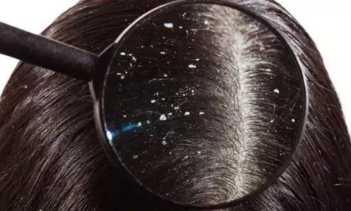 10 smart tricks to drive away dandruff this winter