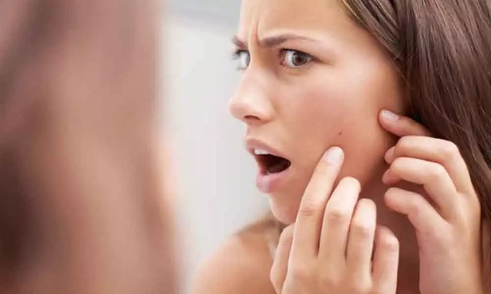 Deal with acne breakouts