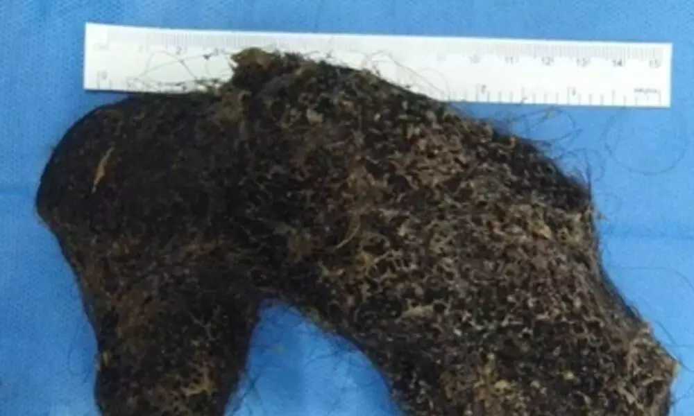 Doctors at Hyderabad hospital remove hairball from Omani girl
