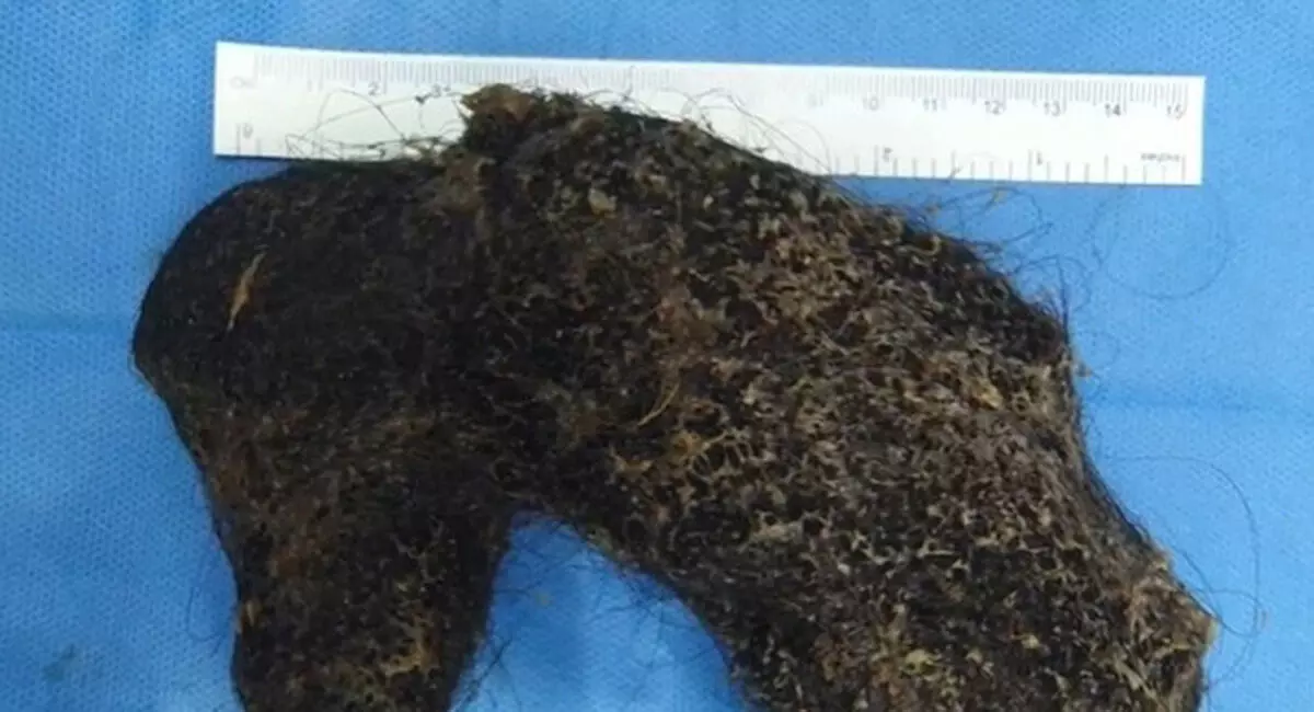 Hyderabad Doctors Removed Hairball from Omani Girls Stomach