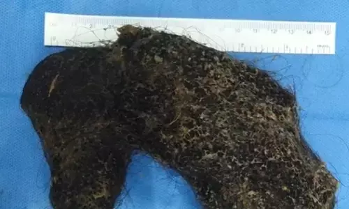 Hyderabad Doctors Removed Hairball from Omani Girls Stomach