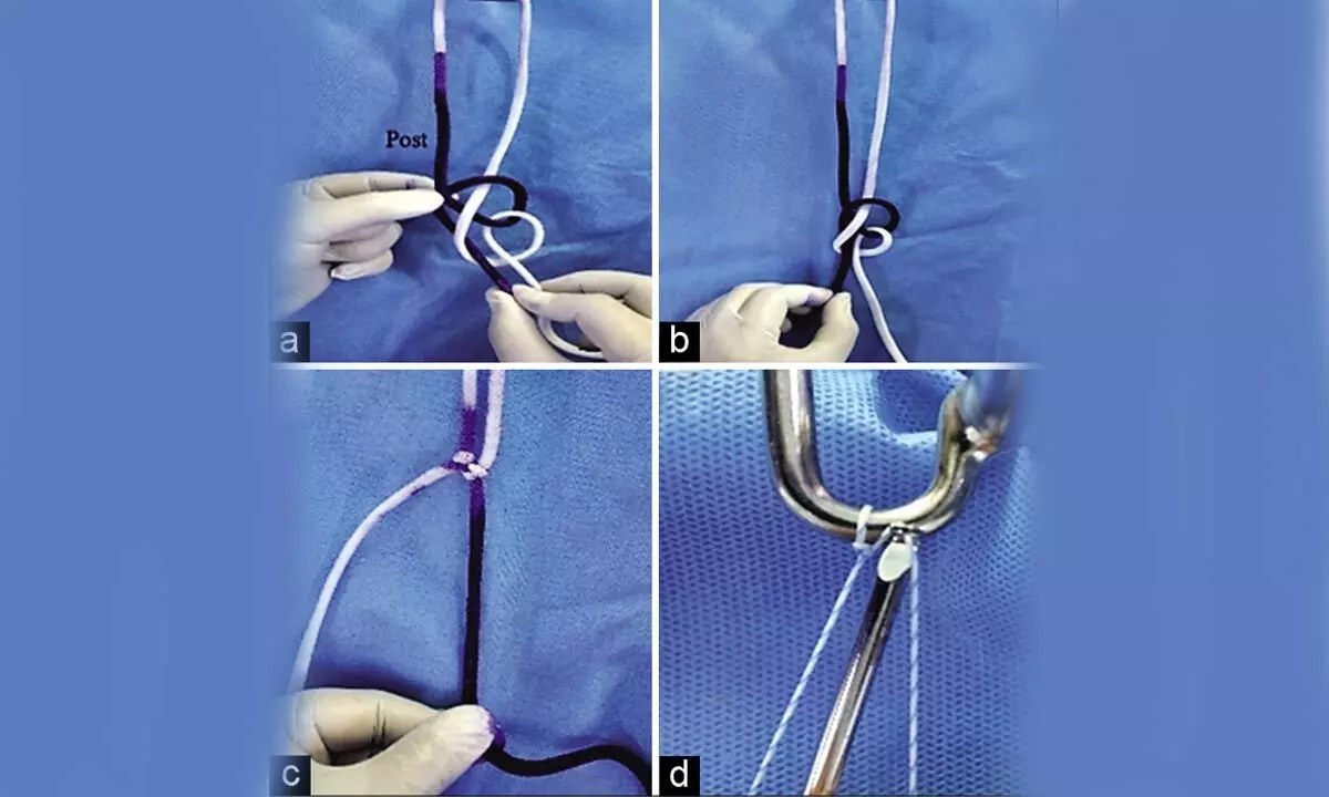 Bengaluru doctor invents new form of arthroscopy knot