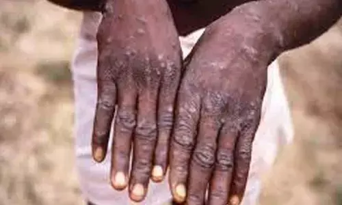 Africa has contained monkey pox outbreaks during COVID pandemic - Africa CDC