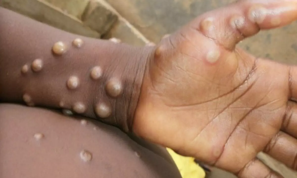 Monkeypox cases confirmed in 12 countries