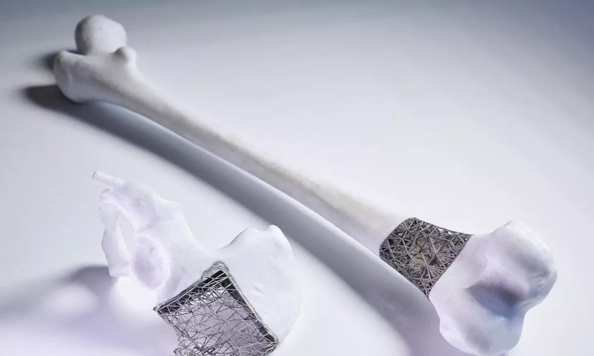 Hospital uses 3D printed implant technology to save techie from bone cancer
