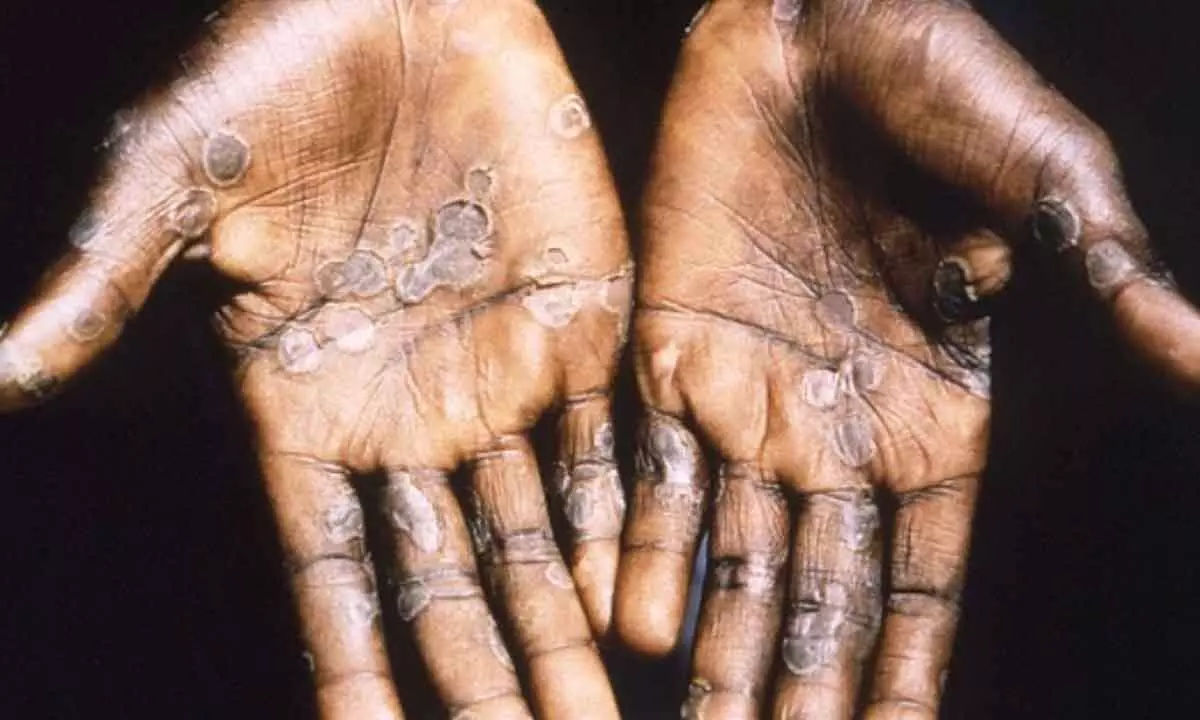 US CDC expects global monkeypox cases to be over 700