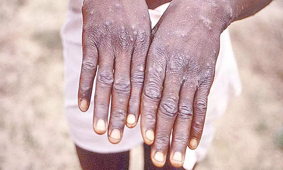 WHO: 780 cases of monkeypox till June 2