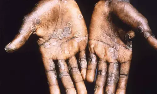 Representative image