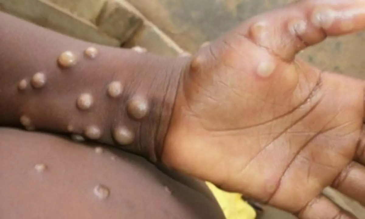 Monkeypox risk higher in children aged 8 or younger: Researchers
