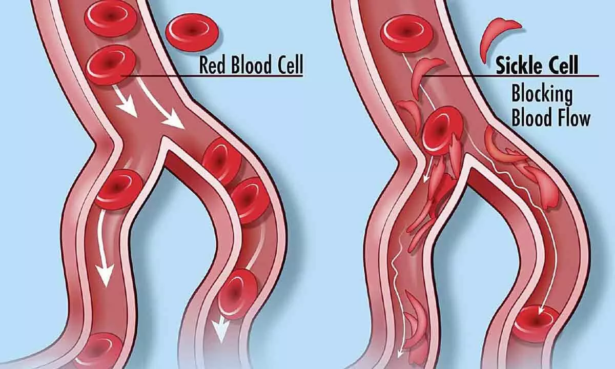 Need to keep tabs on Sickle Cell Disease