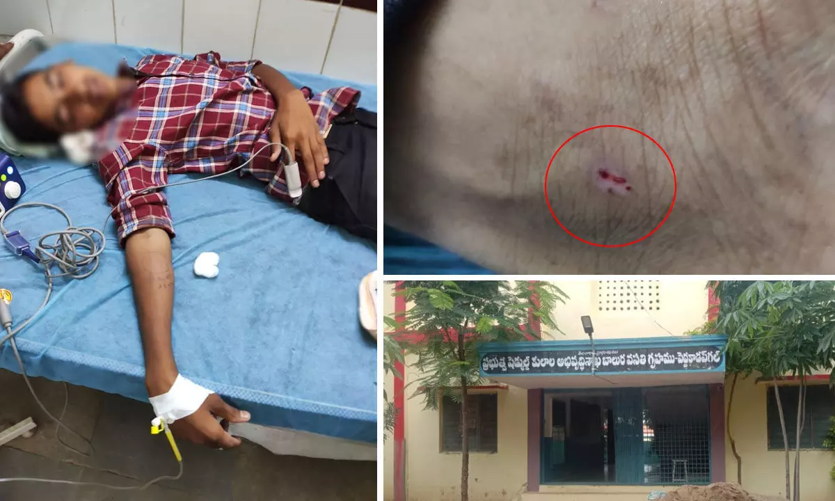 Snake bite triggers panic at Peddakodapgal SC hostel in Nizamabad