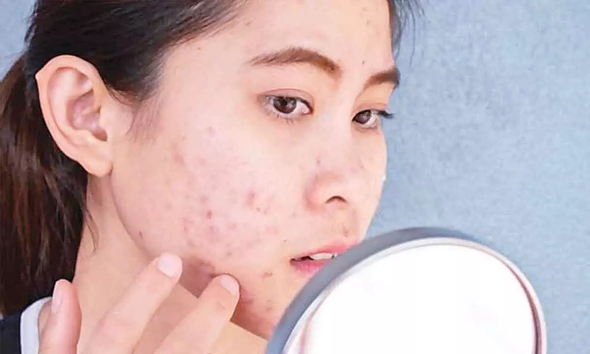 Medicines to prevent an acne breakout before your period