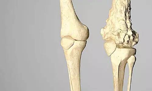 41-year-old bone cancer patient with multiple surgeries gets new lease of life