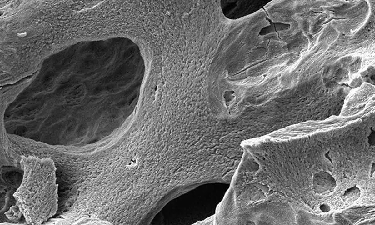 SEM image of osteoporosis. (Science Photo Library - Steve Gschmeissner)