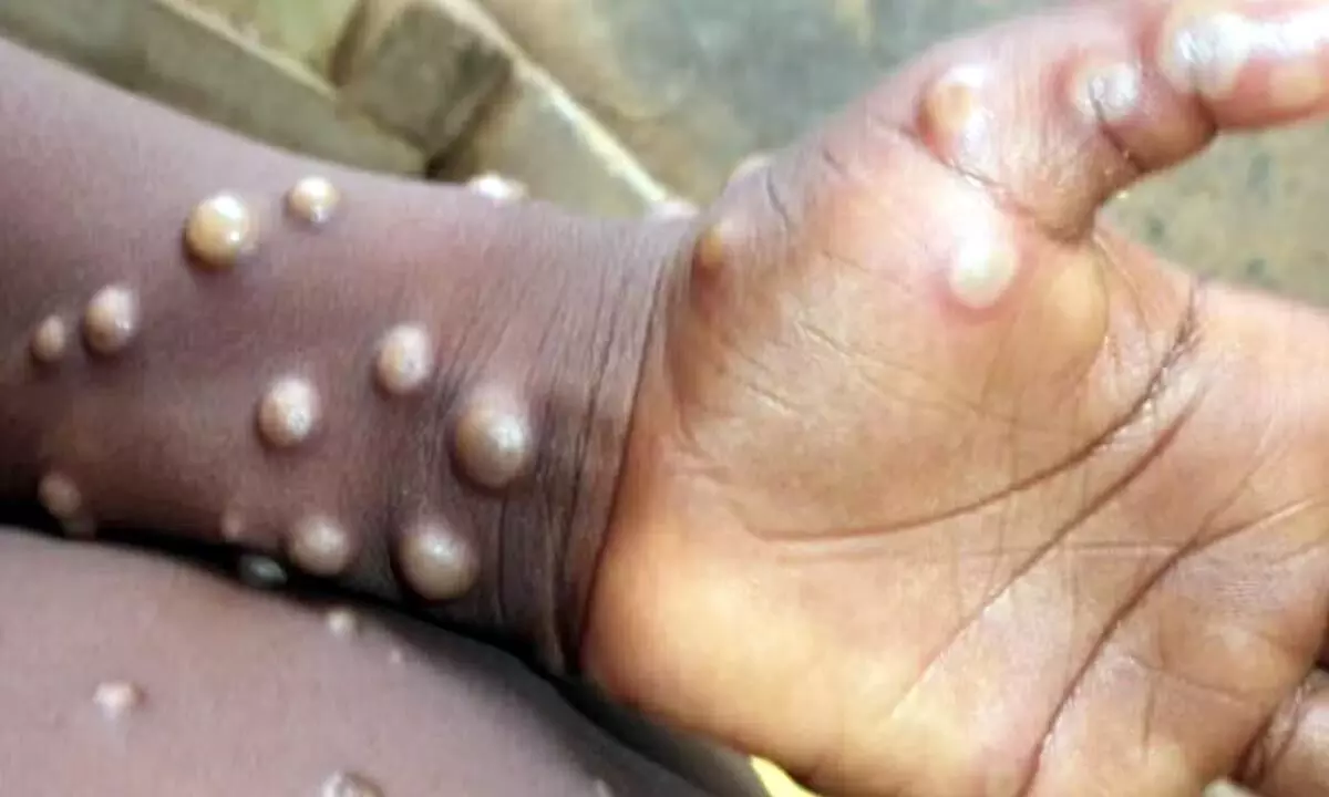 Kerala Reported Its Second Case Of Monkeypox