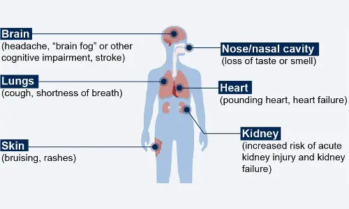 Long COVID: Still no treatment options