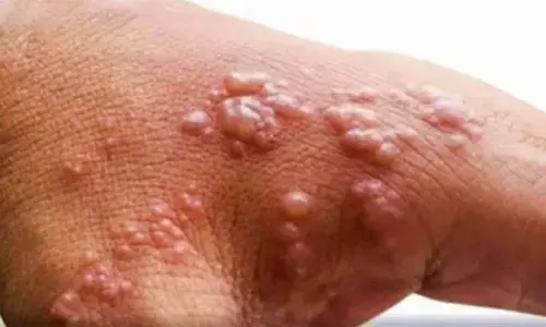 Delhi govt directs 3 private hospitals to create isolation rooms for monkeypox