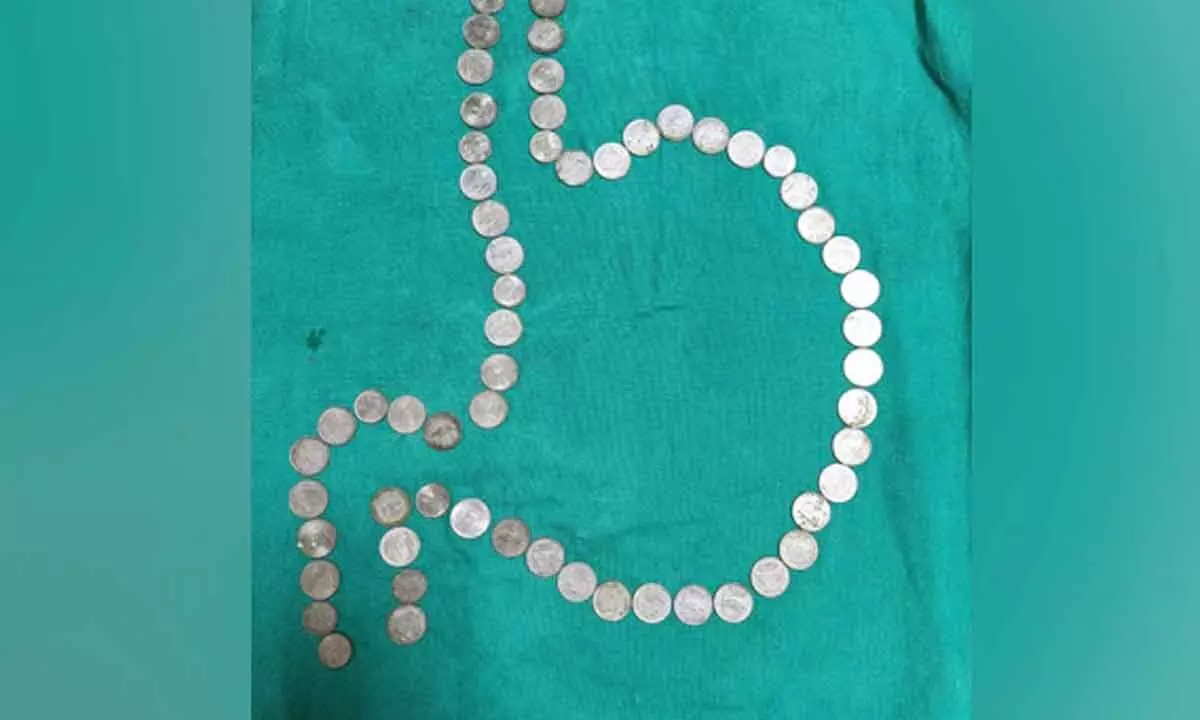 Doctors Remove More Than 50 Coins From Mans Stomach In Rajasthan
