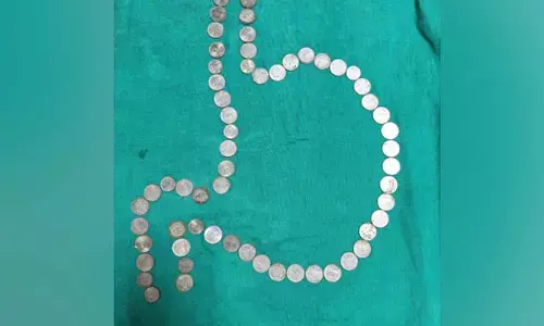 Doctors Remove More Than 50 Coins From Mans Stomach In Rajasthan