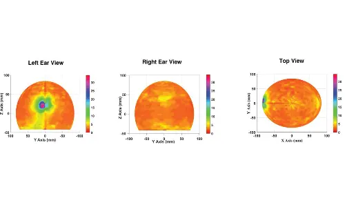 Researchers propose non-invasive diagnostic tool for Epileptogenic Zone Detection
