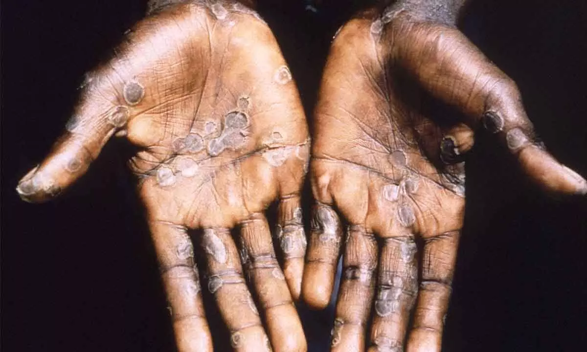 Health authorities warn against increasing local transmission of monkeypox in Australian states