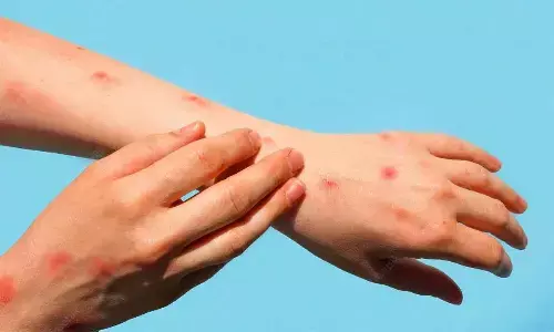 Tomato Flu not related to SARS-CoV-2