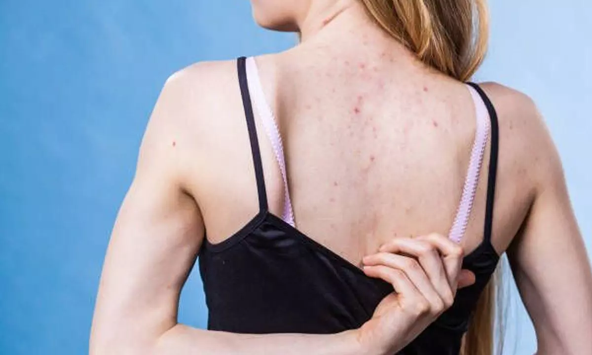 A beginner’s guide to tackling body acne