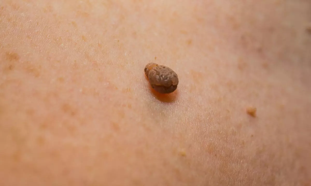 How to get rid of Warts and Skin Tags Naturally?