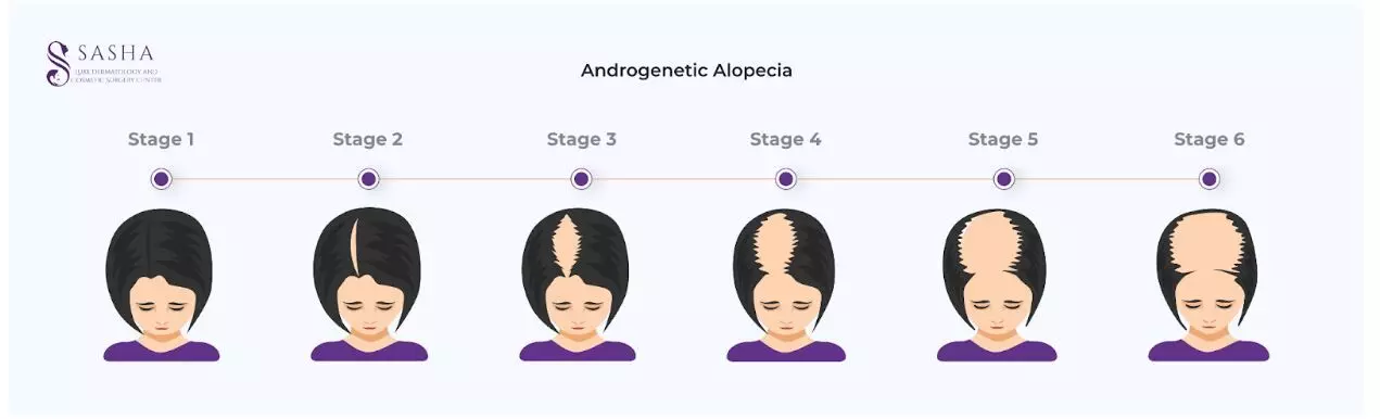 Sasha Luxe on Instagram: Hair loss can be perplexing, but fear not! Let's  unravel the mystery behind common types of hair loss: Androgenetic  Alopecia: This hereditary condition, influenced by hormones, is the
