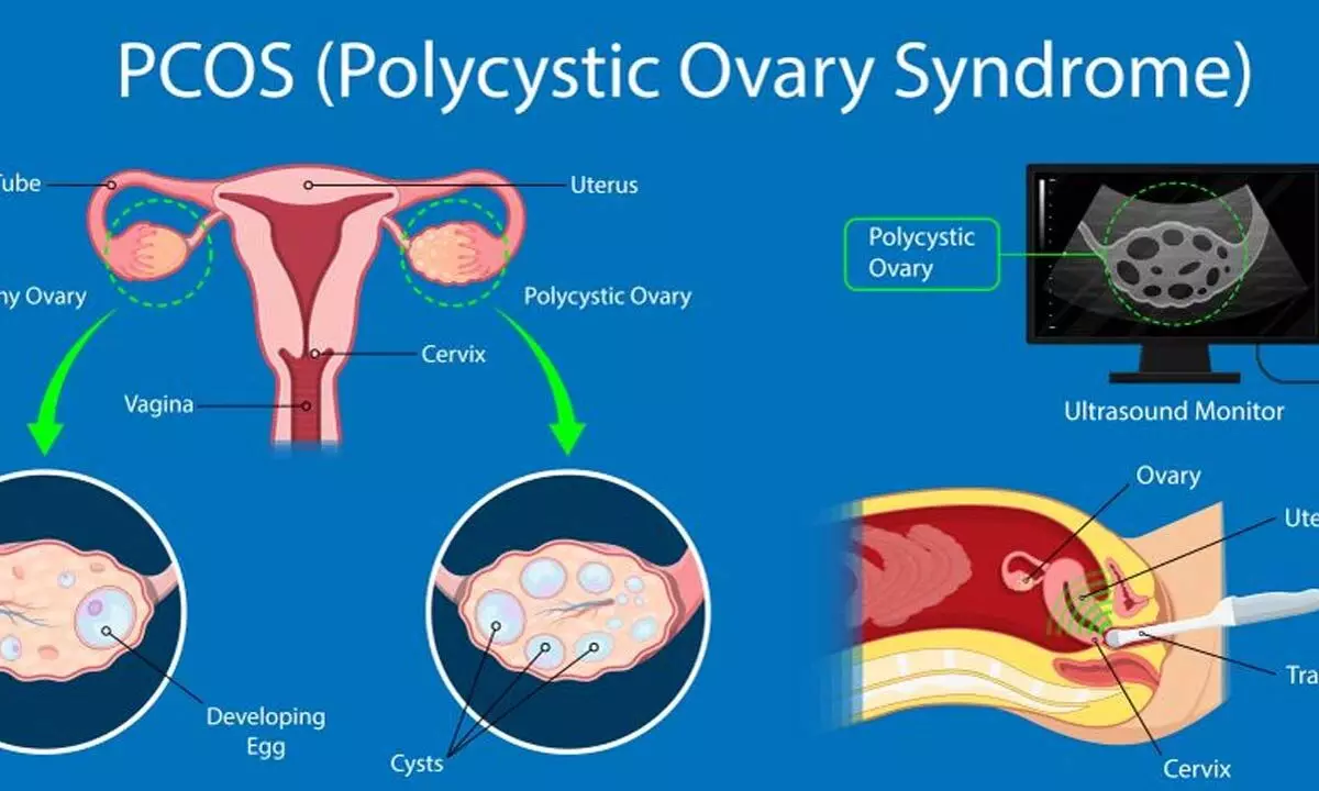 One in five women suffers from PCOS, a leading cause of infertility