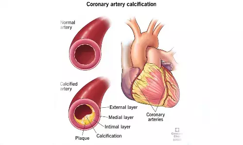 One in 5 asymptomatic individuals diagnosed with calcified plaque in heart