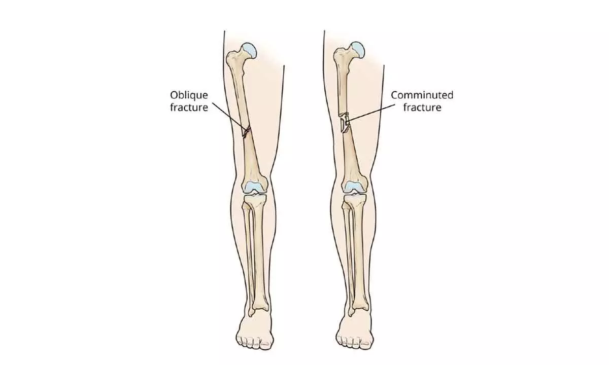 AI model to predict healing of thigh bone fractures