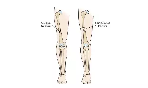 AI model to predict healing of thigh bone fractures