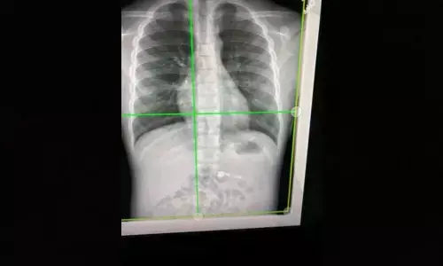 Researchers detect long-Covids impact via simple chest X-rays