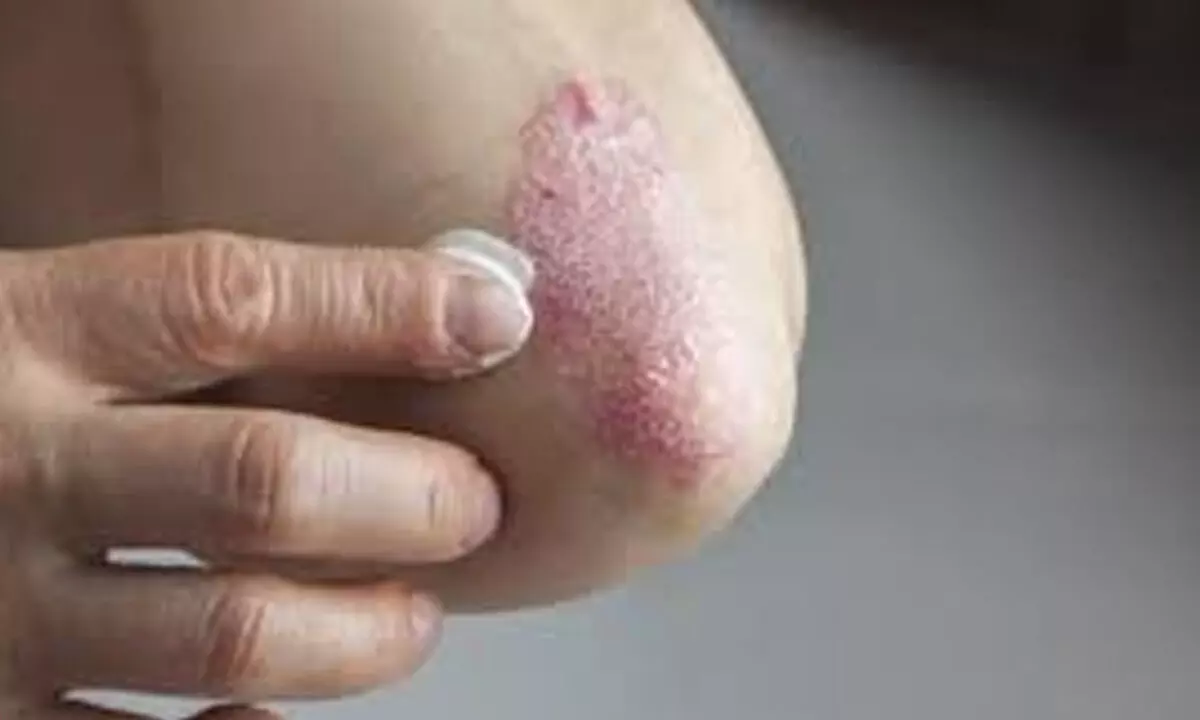 How can you protect your skin from psoriasis this winter season?