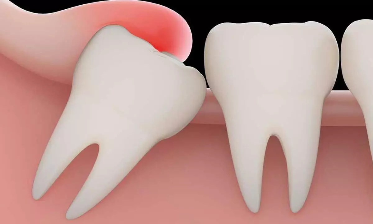 if wisdom tooth gets tooth decay, it is usually best to extract them instead of removing the decay and fixing wisdom tooth with fillings, root canals or crowns