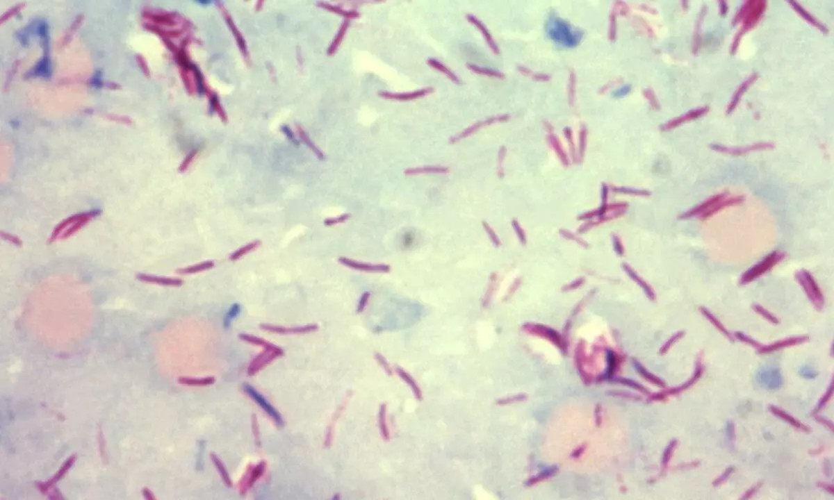 Mycobacterium leprae bacteria in skin smear specimen
