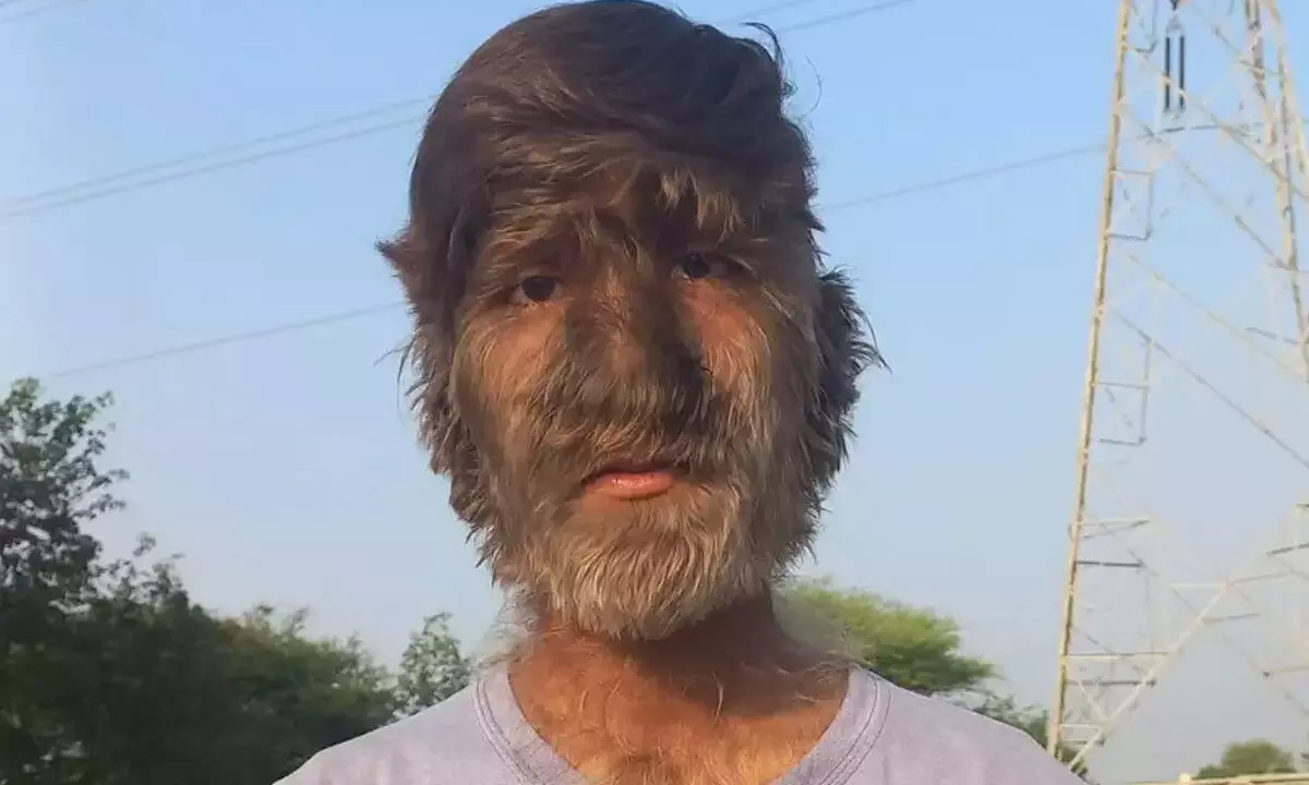 Boy From Madhya Pradesh Is Suffering From Rare Skin Disease