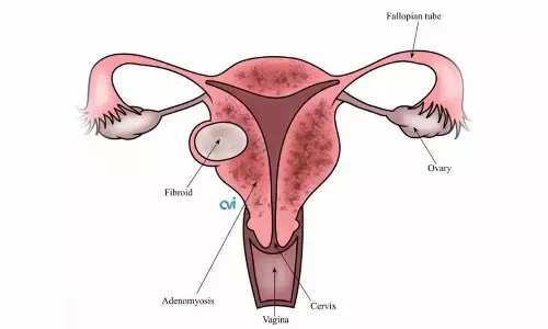 Woman suffering from recurrent pregnancy loss, finally, conceives