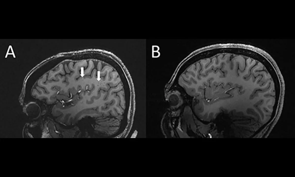 The arrows show enlarged perivascular spaces in the brain of a chronic migraine patient (left) compared to a healthy control (right). (Radiological Society of North America)